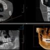 CBCT 3D snimka kompletne gornje i donje čeljusti uz detaljnu analizu snimke, ...