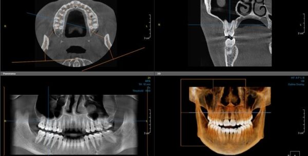 CBCT 3D snimka kompletne gornje i donje čeljusti uz detaljnu analizu snimke, ...