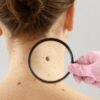Uklanjanje jednog madeža veličine do 1 cm PLASMA PENOM <br>u Privatnoj ordina...
