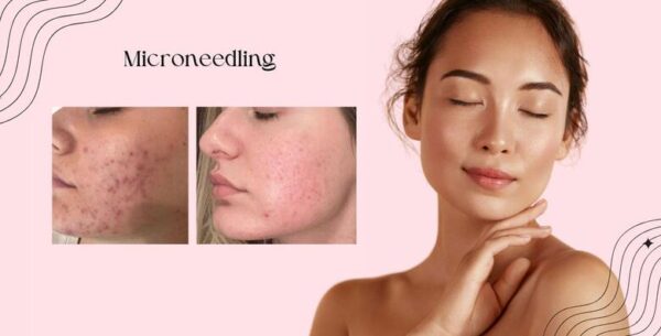 Smanjite mrlje, bore i ožiljke uz MICRONEEDLING i KEMIJSKI PILING <br>za blis...