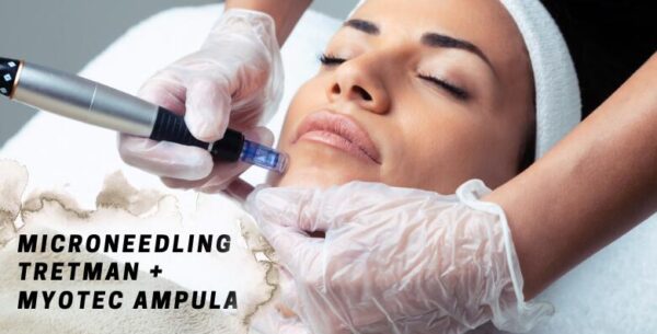 MICRONEEDLING - vratite sjaj i pomladite svoju kožu uz poznatu nekiruršku<br>...
