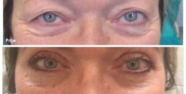 BLEFAROPLASTIKA - obrišite tragove umora s lica uz korekciju gornje ili donje...