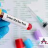 Tumorski marker za žene ili muškarce - otkrijte tumor na vrijeme<br> u Polikl...