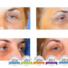 Blefaroplastika - pomladite se uz zahvat na oba oka i uključenu anesteziju i ...