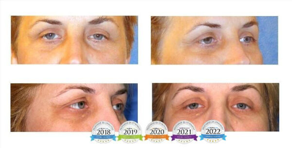Blefaroplastika - pomladite se uz zahvat na oba oka i uključenu anesteziju i ...