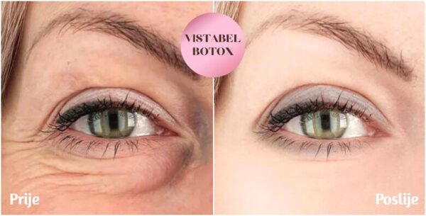 Vistabel 12 jedinica i 0.5 ml svjetski poznatog Restylane filera - najučinkov...