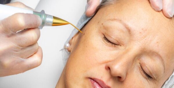 Uklanjanje bradavice, keratoze ili fibroma inovativnim tretmanom PLASMA<br> P...